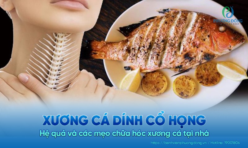 Xương cá dính cổ họng: Hệ quả và các mẹo chữa hóc xương cá tại nhà