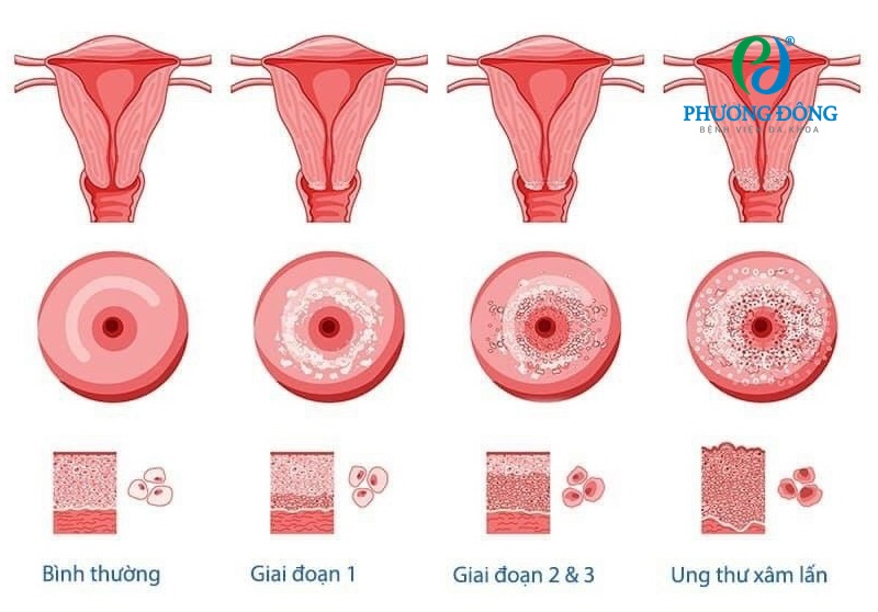 Hình ảnh mô phỏng các giai đoạn ung thư cổ tử cung