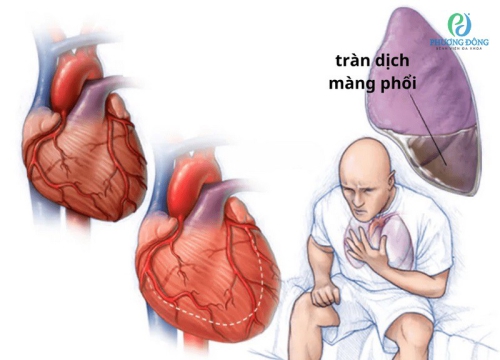 Suy tim gây tràn dịch màng phổi có nguy hiểm?