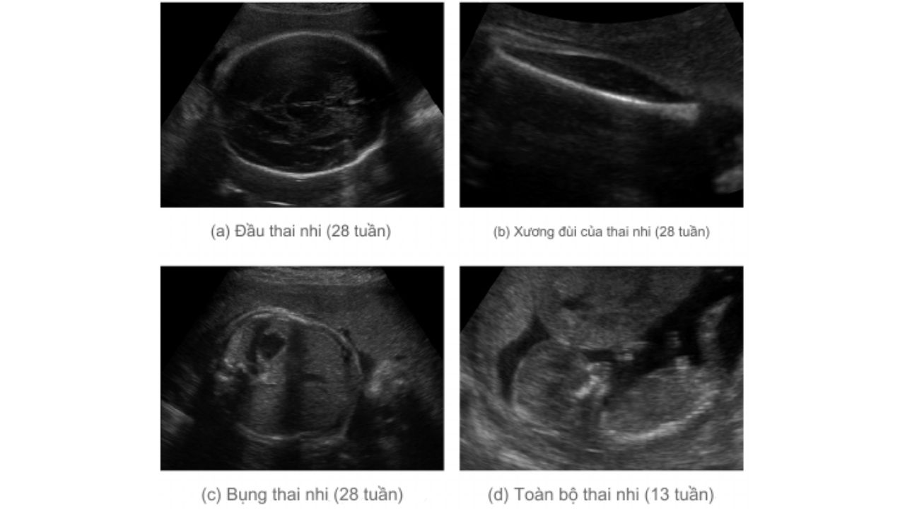 (Hình 6 - Đo chu vi vòng đầu và các chỉ số cho thai nhi vào tuần 28 của thai kỳ)