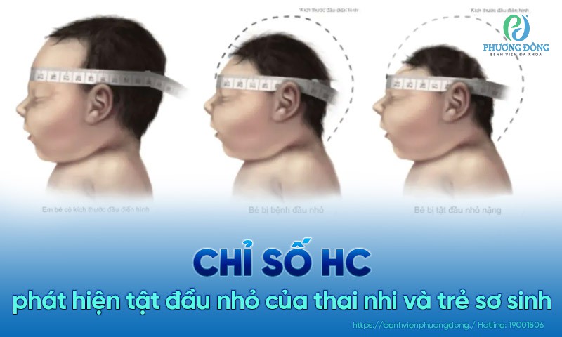 (Hình 7 - Tật đầu nhỏ có thể phát hiện qua chỉ số HC trong siêu âm thai và sau sinh)