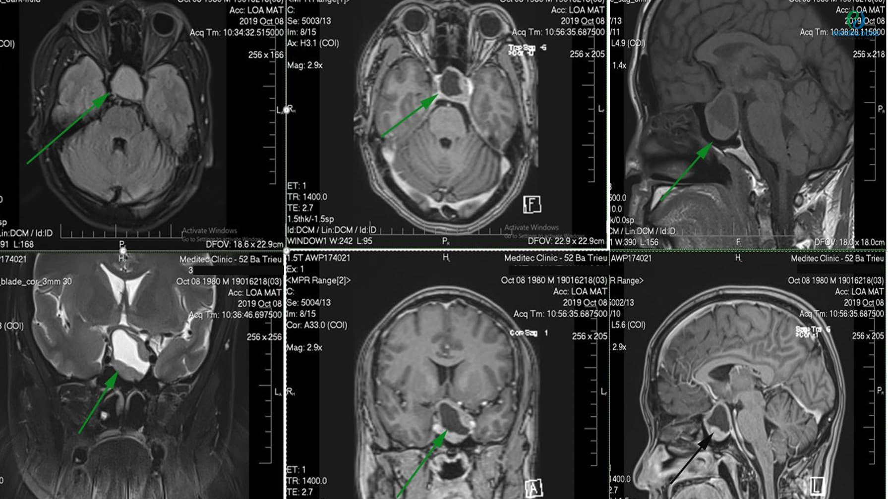 Hình ảnh 0 - Chụp MRI giúp phát hiện và theo dõi bệnh lý bên trong cơ thể