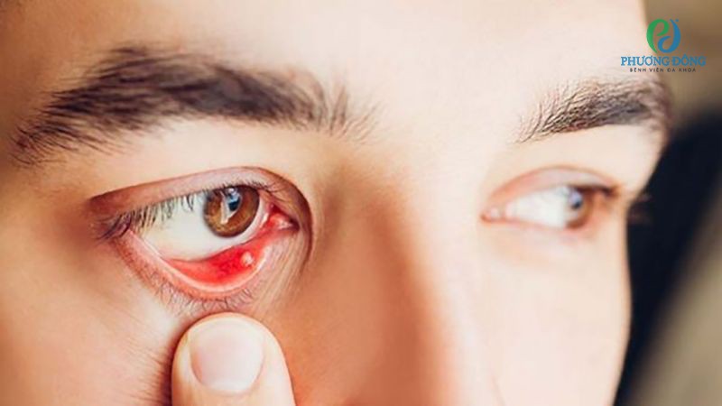 Thuốc nhỏ mắt cần được sử dụng theo chỉ định của bác sĩ chuyên khoa