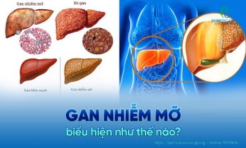 Gan nhiễm mỡ: Nguyên nhân - Dấu hiệu và Cách điều trị