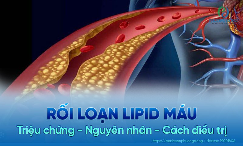 Rối loạn lipid máu chỉ sự mất cân bằng giữa LDL-C với HDL-C