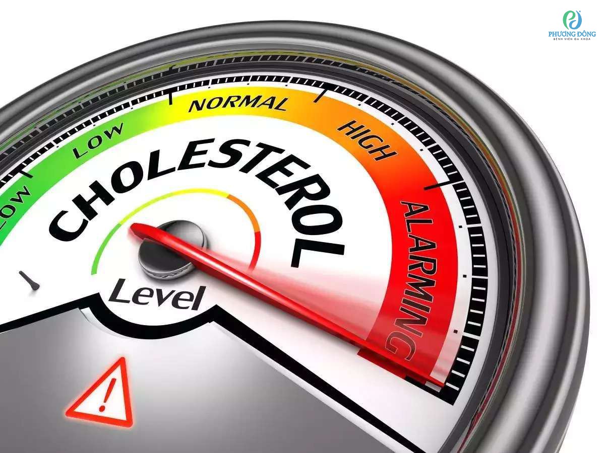 Kết luận rối loạn lipid máu khi chỉ số cholesterol xấu tăng cao