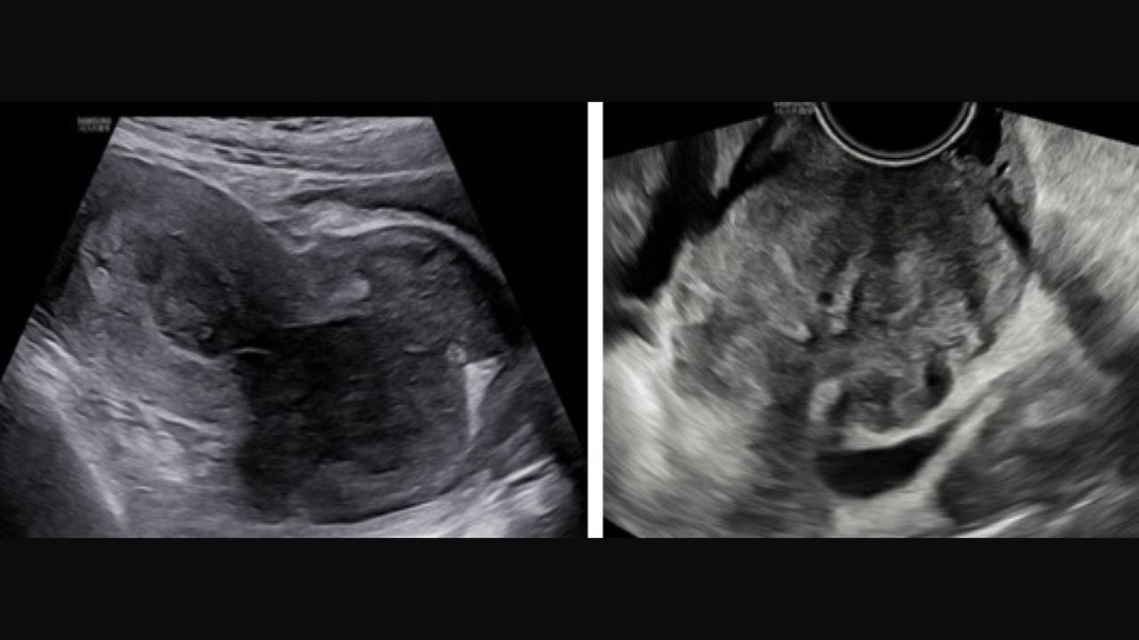 (Hình 7 - Siêu âm ổ bụng (trái) và siêu âm đầu dò (phải) phát hiện tổn thương tử cung)