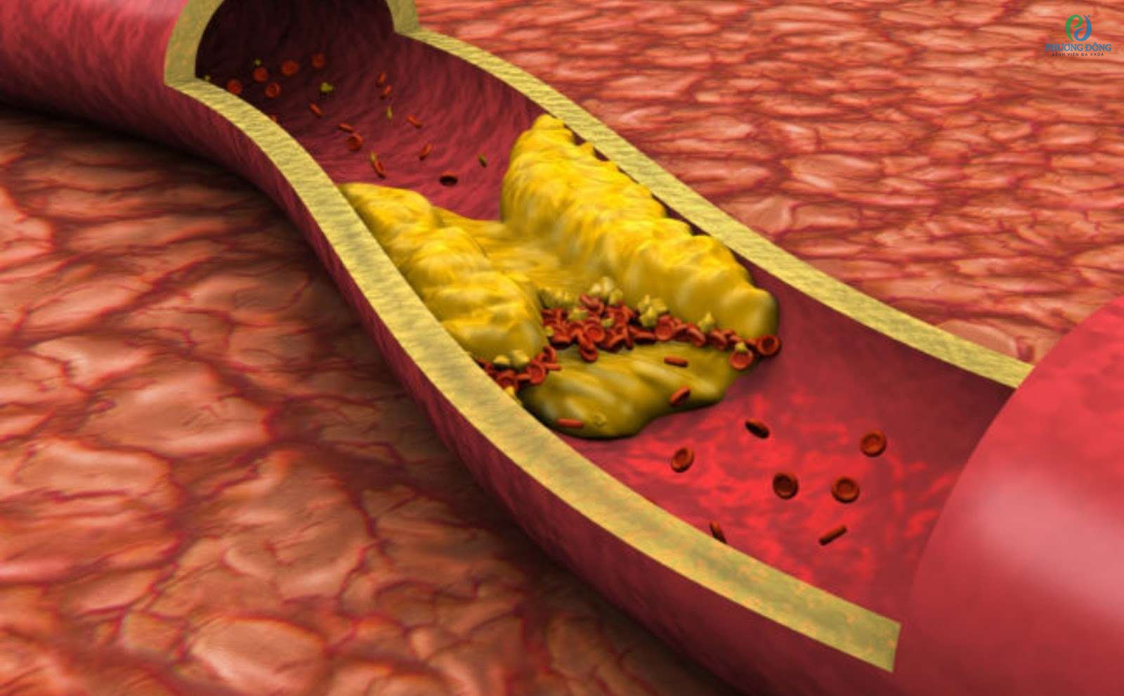 Tăng lipid máu là tình trạng nồng độ chất béo trong máu tăng cao bất thường