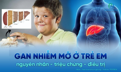 Trẻ em bị gan nhiễm mỡ: Nguyên nhân - Triệu chứng - Cách điều trị