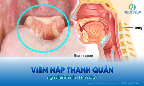Viêm nắp thanh quản nguy hiểm như thế nào?