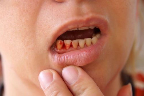Tại sao sốt xuất huyết chảy máu chân răng? Nguyên nhân và cách điều trị