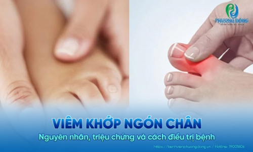 Viêm khớp ngón chân: Nguyên nhân, triệu chứng và cách điều trị bệnh