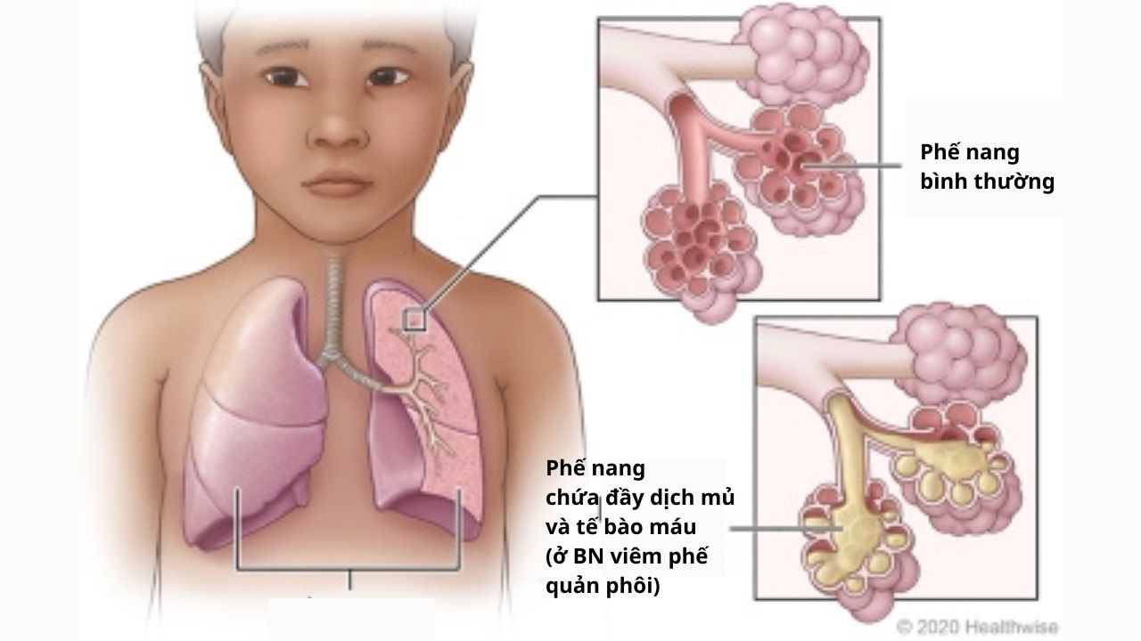 (Hình - Viêm phế quản phổi ở trẻ em)