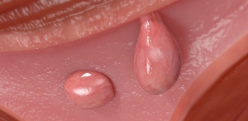 Phẫu thuật cắt polyp cổ tử cung: Quy trình thực hiện và lưu ý 