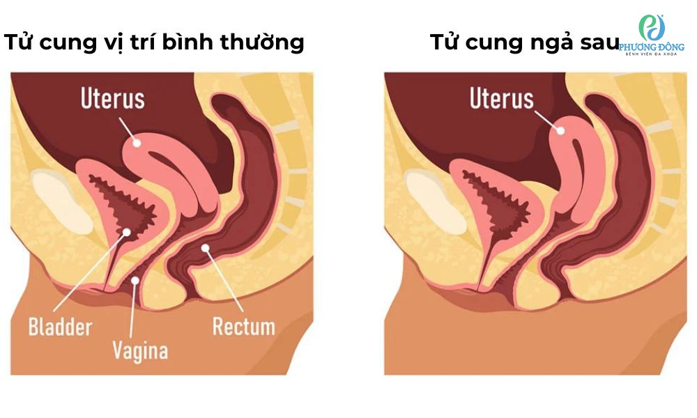 Hình ảnh tử cung bình thường và tử cung ngả sau