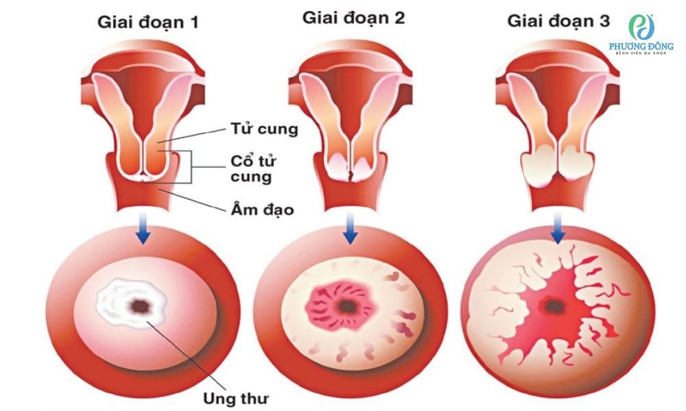 Ba giai đoạn tiến triển của ung thư tử cung