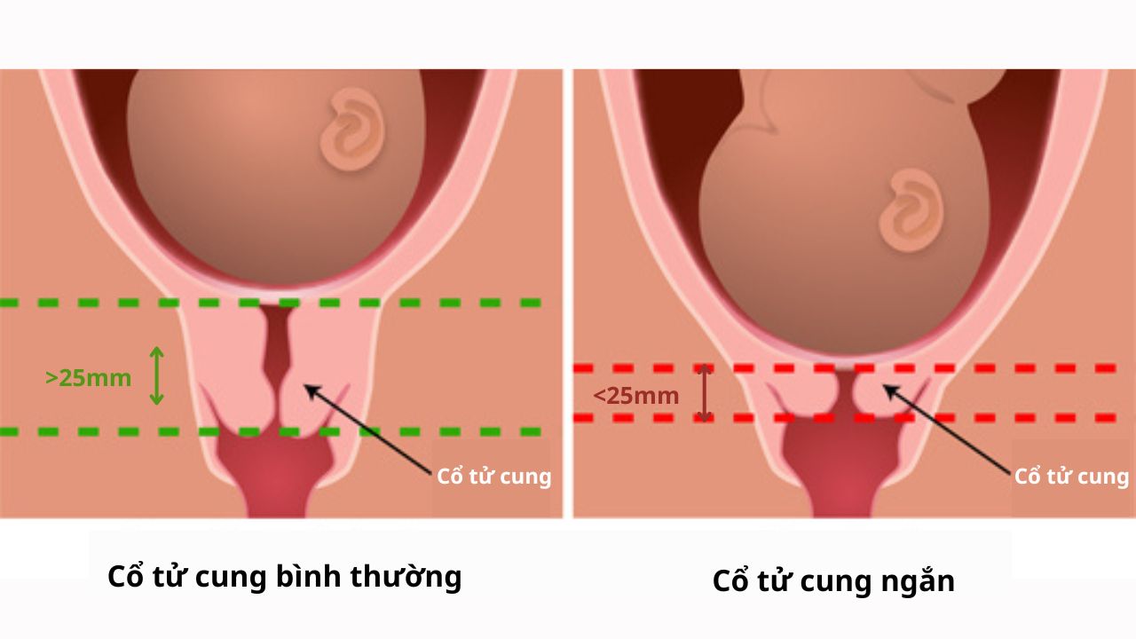 (Hình 1 - Cổ tử cung ngắn là tình trạng cổ tử cung có chiều dài >25mm (~2,5cm) vào tuần thứ 20 của thai kỳ)