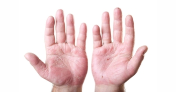 Da tay bị khô vì thiếu chất gì? Cách trị khô da tay tại nhà 
