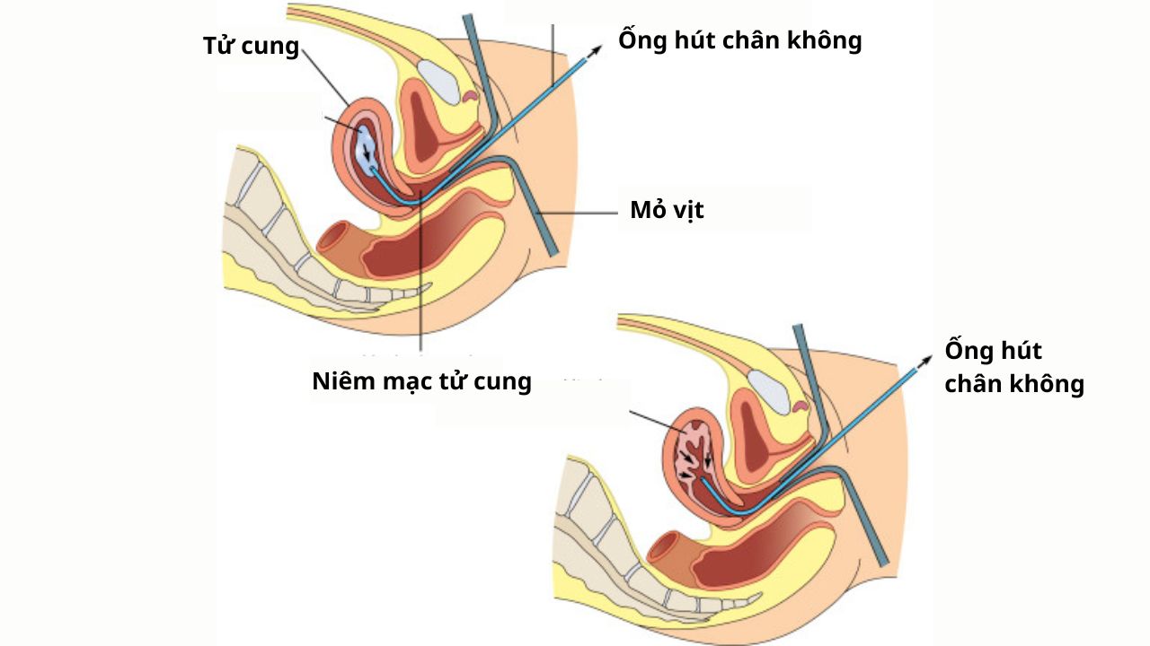 (Hình 2 - Hút buồng tử cung là thủ thuật hút tổ chức ra bằng ống mềm dưới áp lực âm thường được chỉ định điều trị rong kinh)
