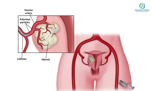 Nút mạch u xơ tử cung: Chỉ định và chống chỉ định thực hiện