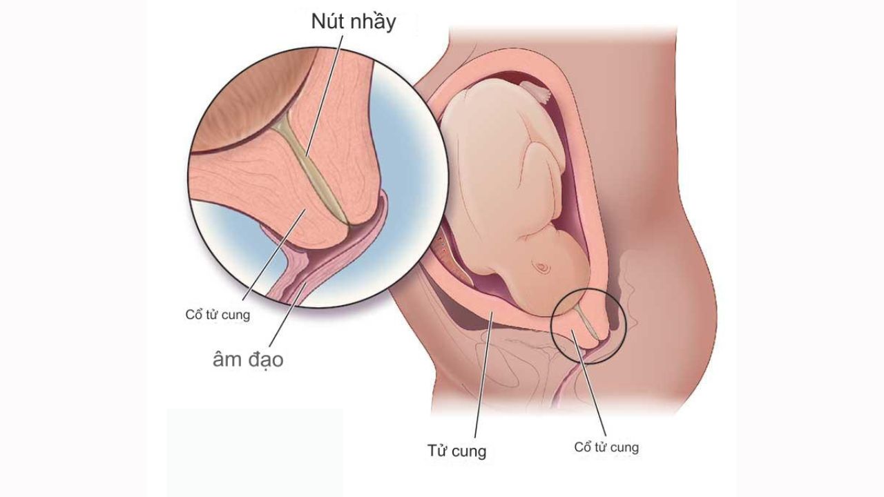 (Hình 1 - Nút nhầy giúp em bé được an toàn phát triển, tránh khỏi sự xâm nhập của vi khuẩn trong suốt thai kỳ)