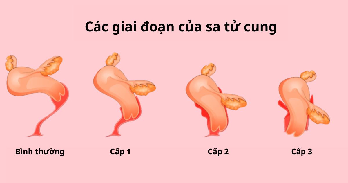 Triệu Chứng Sa Tử Cung Cấp Độ 1