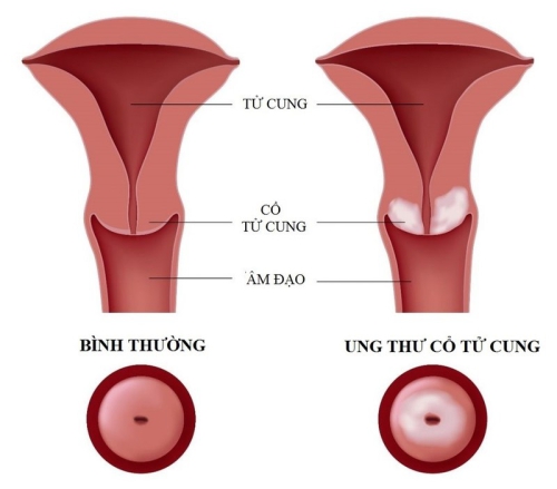 Tầm soát ung thư cổ tử cung là gì? Phương pháp, quy trình 