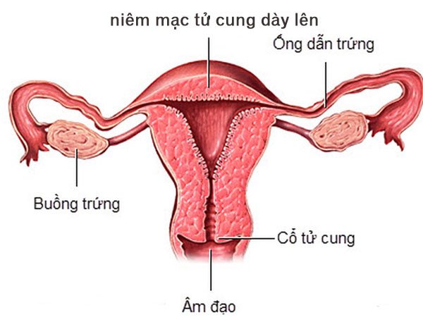 Niêm mạc tử cung dày sẽ ảnh hưởng tới khả năng sinh sản của chị em phụ nữ.