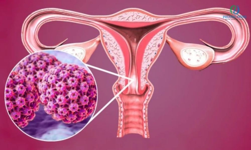Tiền ung thư cổ tử cung: Nguyên nhân, triệu chứng, phân loại tổn thương