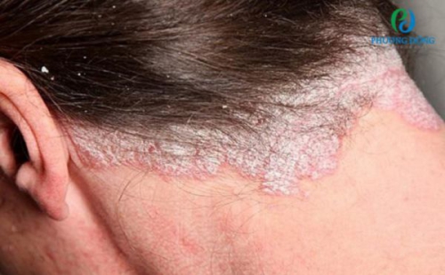 Vảy nến da đầu: Nguyên nhân, dấu hiệu và phương pháp điều trị bệnh