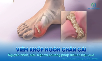 Viêm khớp ngón chân cái: Nguyên nhân, biểu hiện và phương pháp điều trị hiệu quả