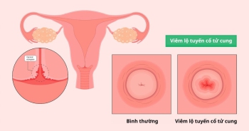 Bệnh viêm lộ tuyến cổ tử cung có nguy hiểm không? 