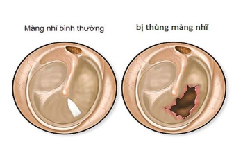Viêm tai giữa thủng màng nhĩ: Nguyên nhân, triệu chứng, điều trị và cách phòng ngừa