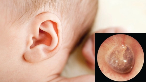 Viêm tai giữa ứ dịch: Nguyên nhân, triệu chứng, điều trị và cách phòng ngừa