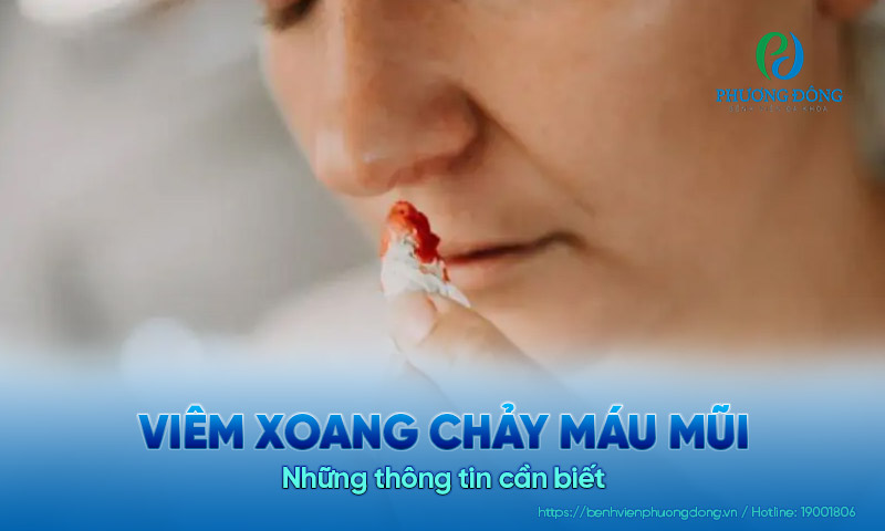 Những thông tin cần biết về viêm xoang chảy máu mũi