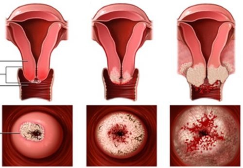 Viêm xung huyết cổ tử cung: Nguyên nhân, triệu chứng, điều trị và cách phòng ngừa
