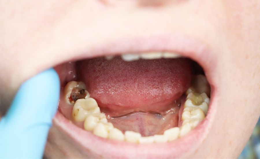 Giải đáp thắc mắc: Bé 5 tuổi bị sâu răng hàm phải làm sao?