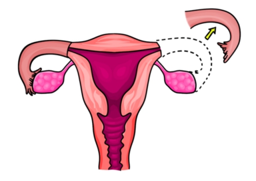 Trứng rụng bên vòi bị cắt có bơm tinh trùng vào tử cung được không?