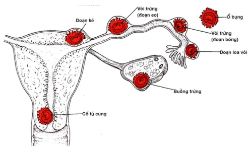 Có thai lại sau chửa ngoài tử cung - Những điều mà mẹ bầu nên biết