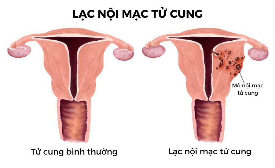 7. Cách Phòng Ngừa Lạc Nội Mạc Tử Cung