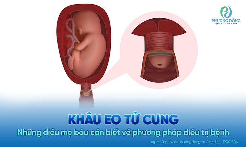 Những điều mẹ bầu cần biết về phương pháp khâu eo tử cung 