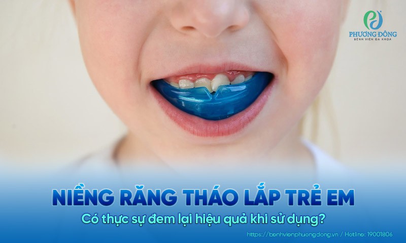 Có nên sử dụng niềng răng tháo lắp trẻ em hay không?