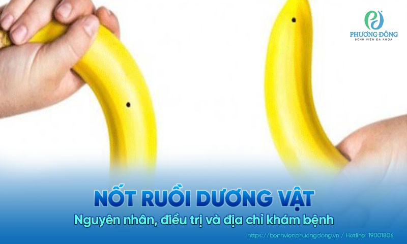 Nốt ruồi dương vật: Nguyên nhân, điều trị và địa chỉ khám bệnh