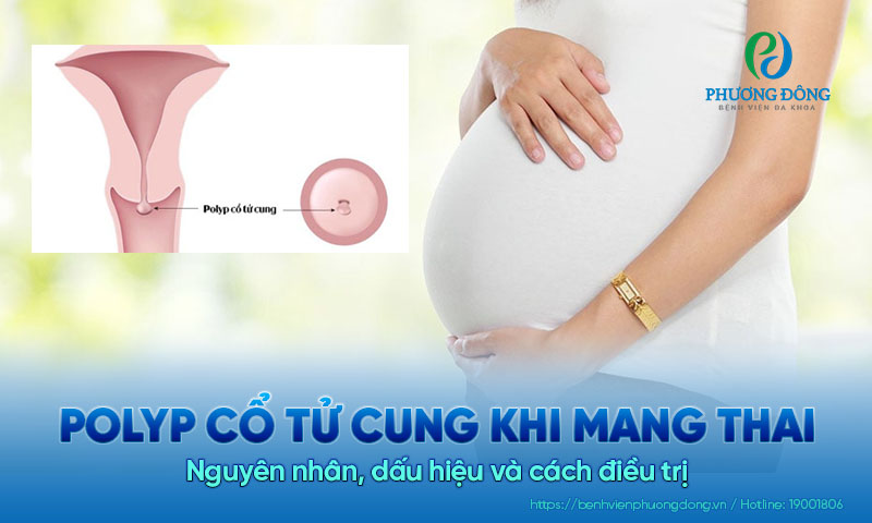 Nguyên nhân, triệu chứng và cách điều trị polyp cổ tử cung khi mang thai