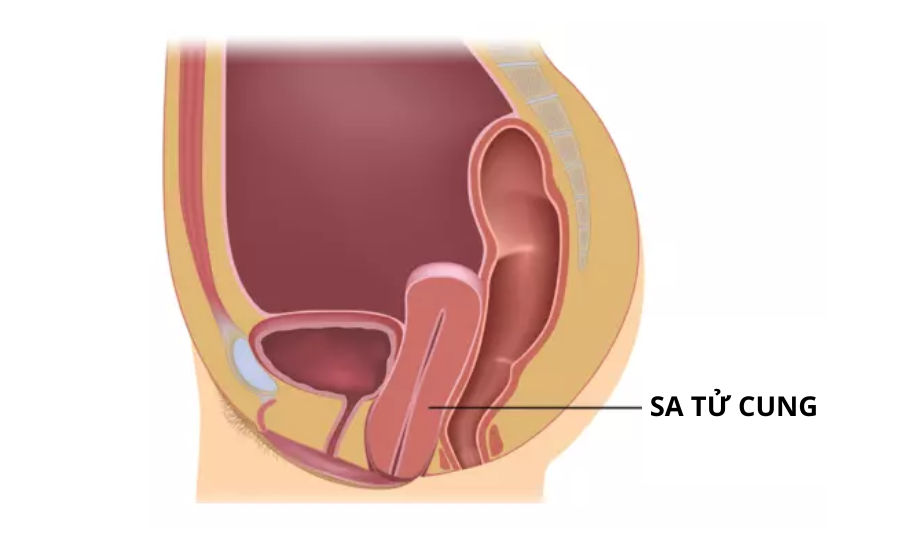 Giải đáp thắc mắc: Sinh mổ có bị sa tử cung không?