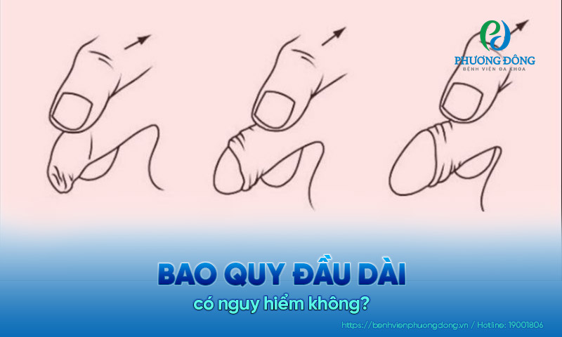 Bao quy đầu dài có nguy hiểm không? Xử lý như thế nào?