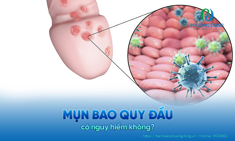 Mụn ở bao quy đầu có sao không? Báo hiệu bệnh lý gì?