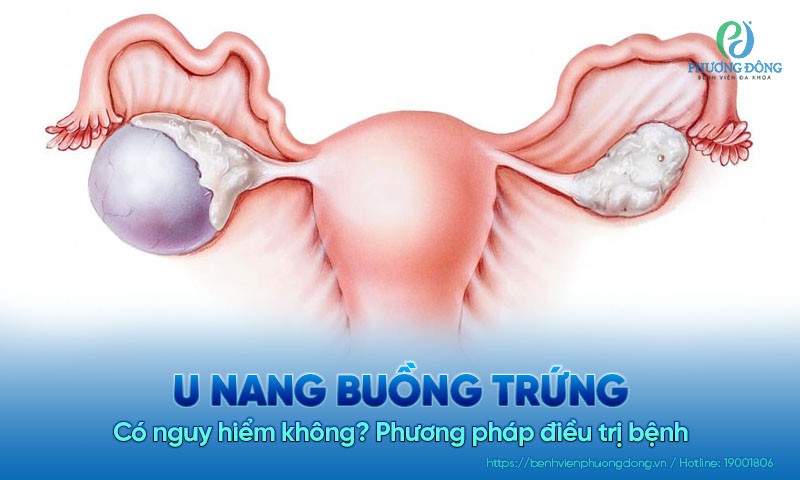 U nang buồng trứng có nguy hiểm không? Cách điều trị dứt điểm