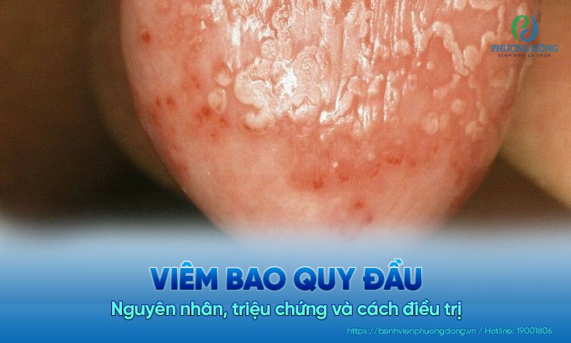 Viêm bao quy đầu: Nguyên nhân, triệu chứng và cách điều trị