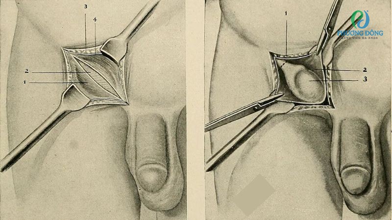 1 bên tinh hoàn nếu khỏe mạnh vẫn có thể sinh con bình thường